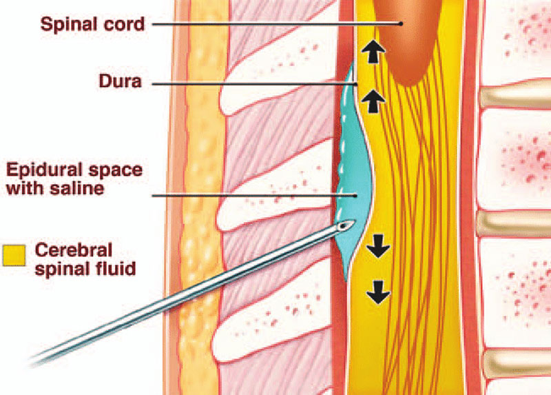 اپیدورال و اسپاینال در زایمان طبیعی