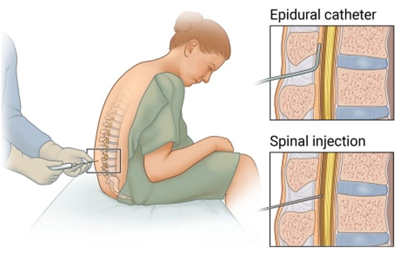 اپیدورال و اسپاینال در زایمان طبیعی
