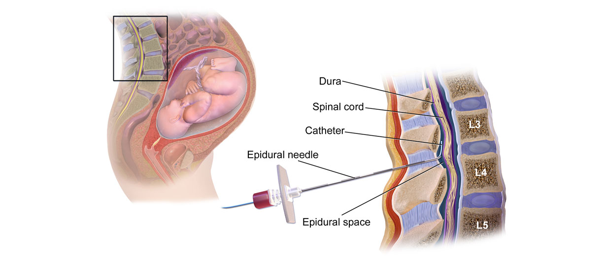 اپیدورال و اسپاینال در زایمان طبیعی