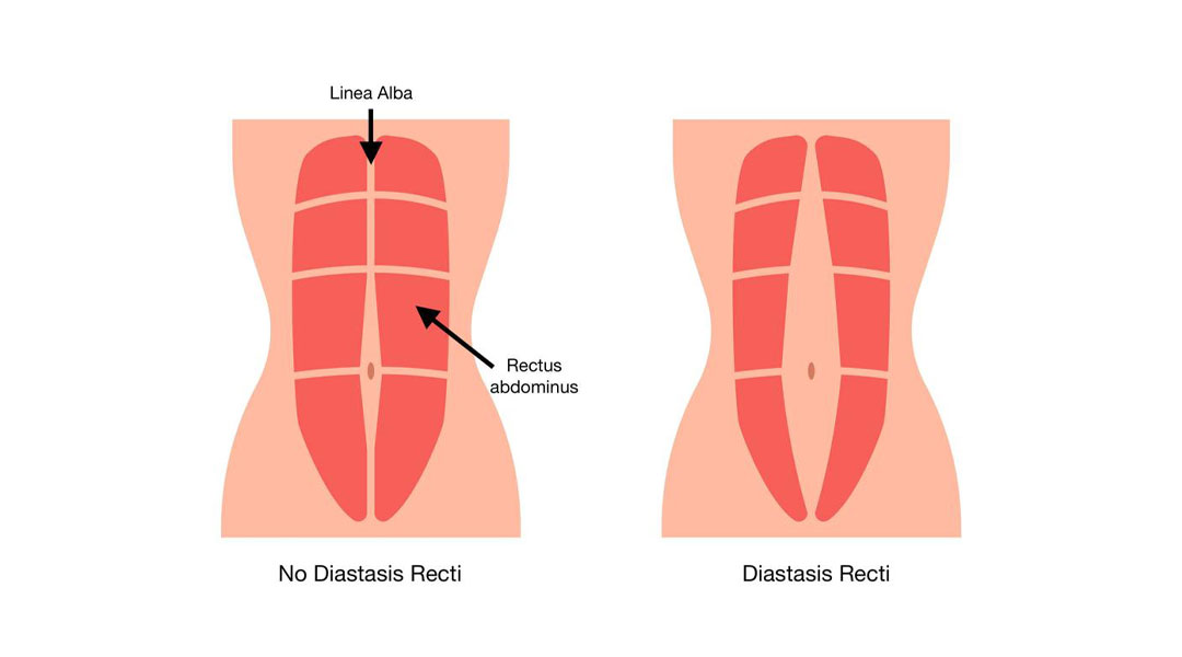 گن بعد زايمان يا گناژ